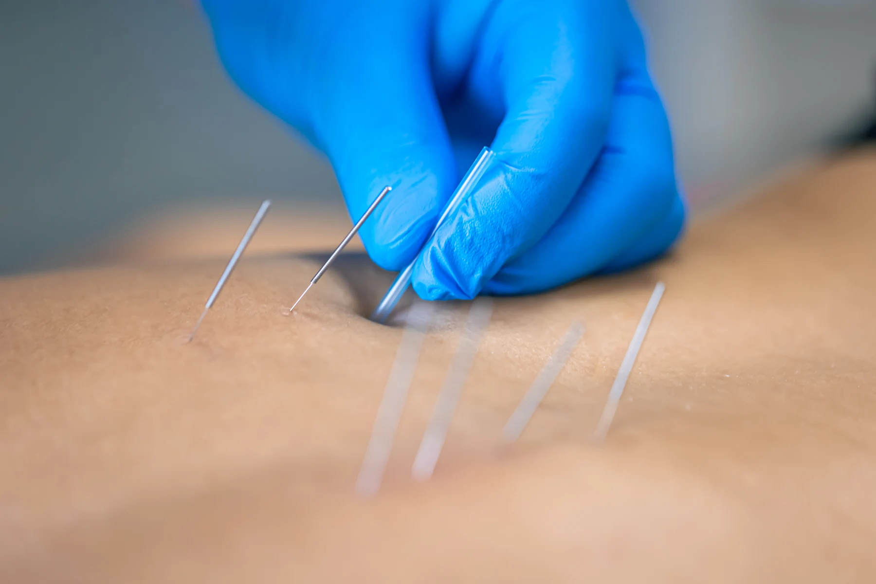 Gloved practitioner placing acupuncture needles in a patient’s back