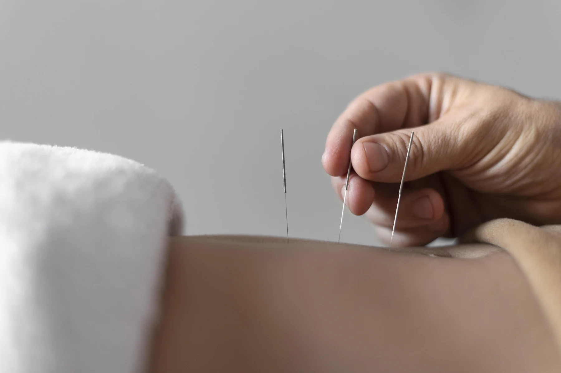 Practitioner placing a fine acupuncture needle