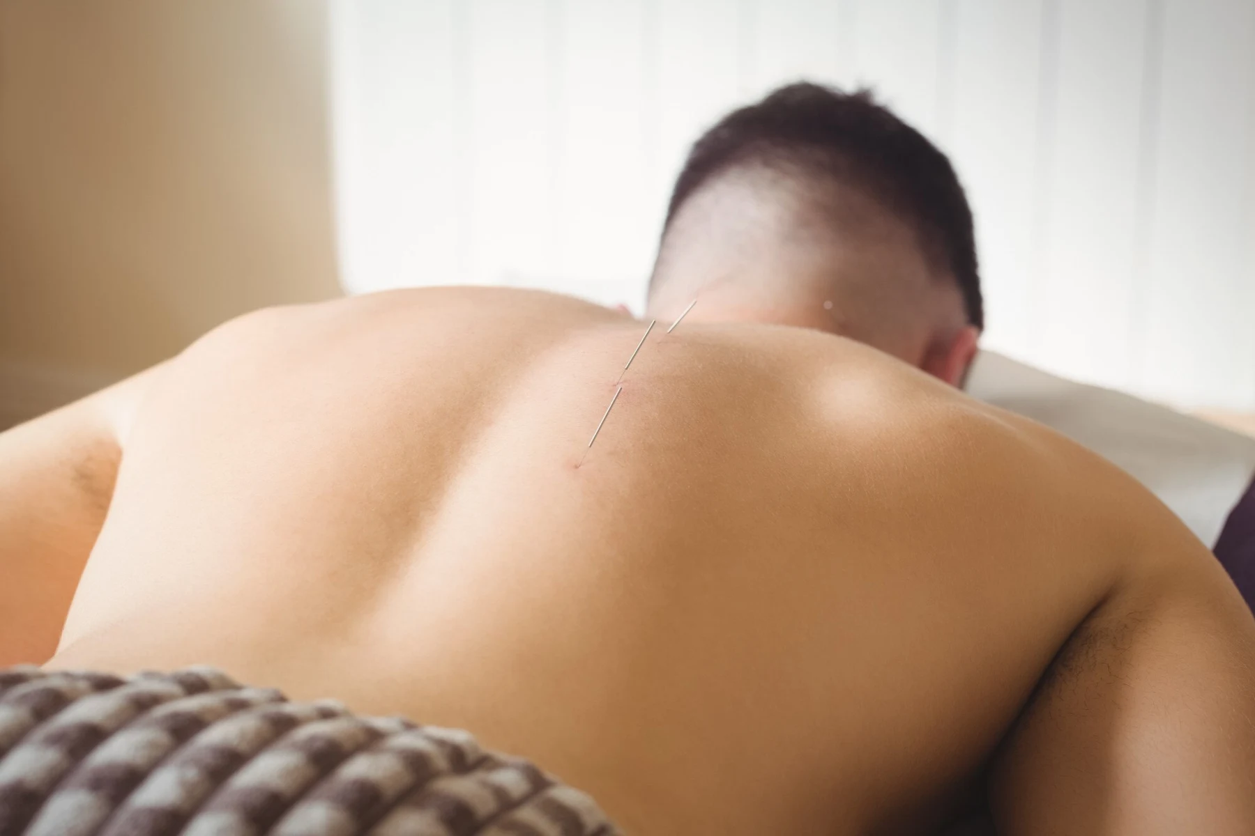 Patient lying face down with acupuncture needles in the back